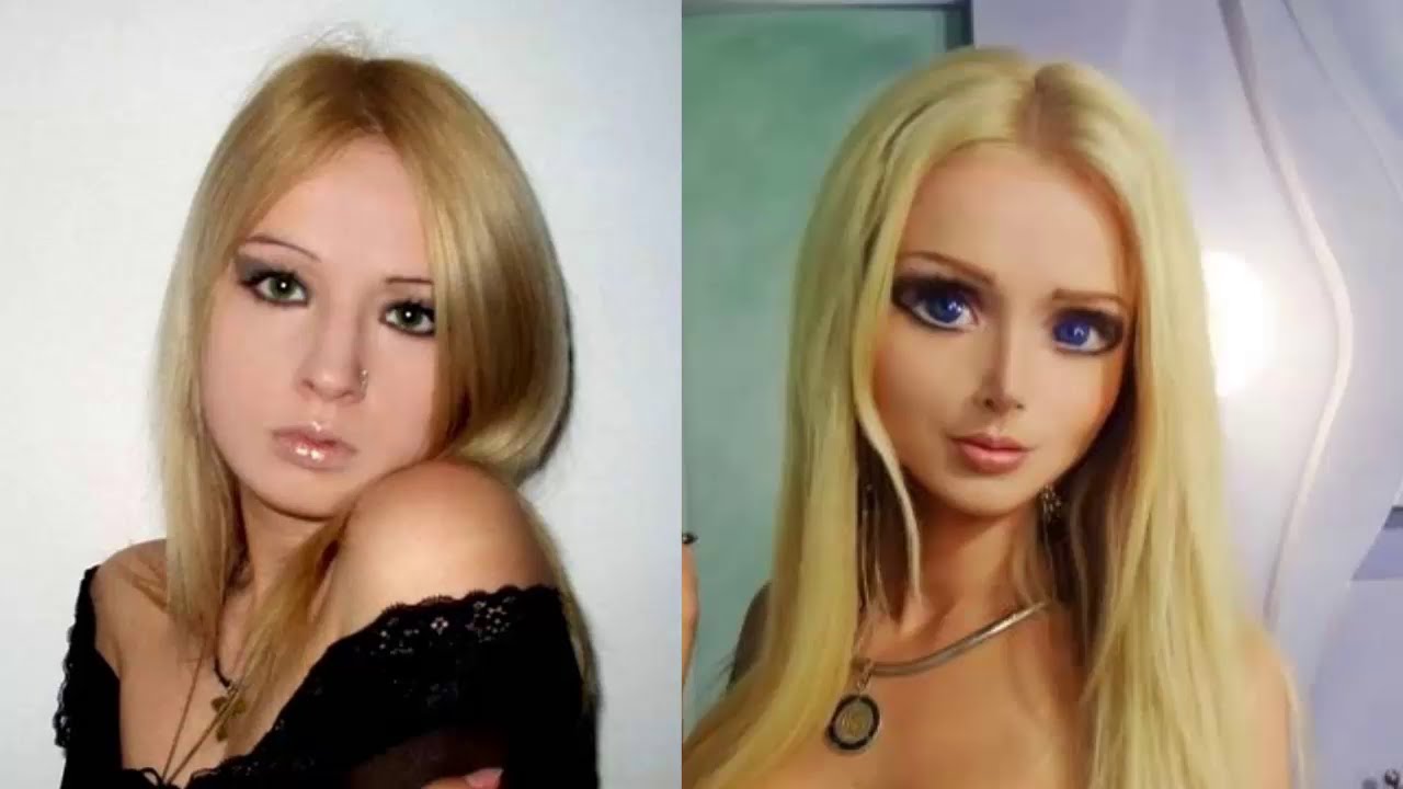 Así Se Veía La ‘barbie Humana Antes De Sus Operaciones