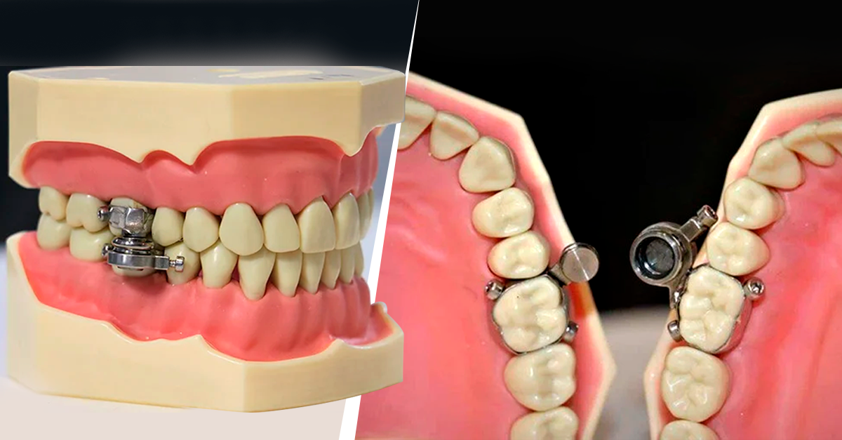 Nuevo invento que cierra mandíbula para bajar de peso